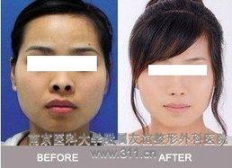 隆鼻切口图片,切口图片解析与手术概述